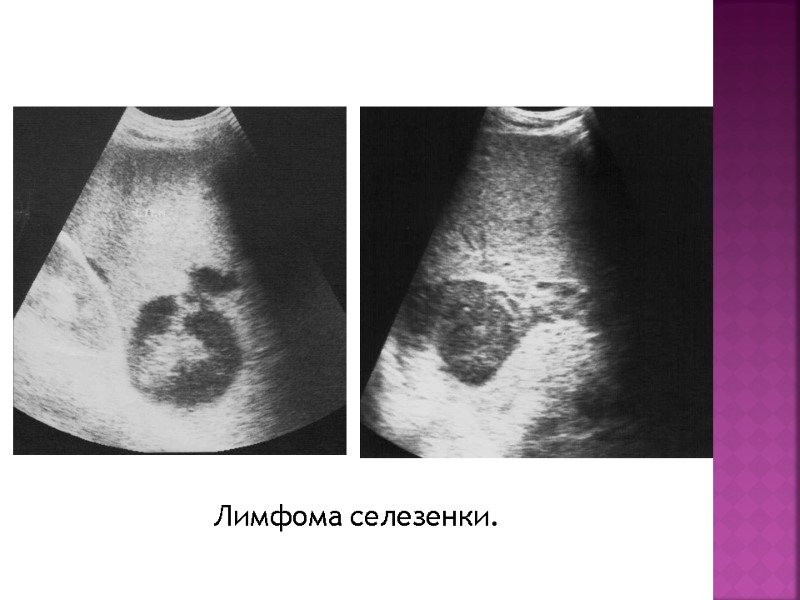 Лимфома селезенки.